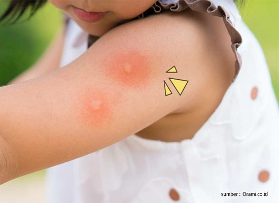 cara menghindari gigitan nyamuk